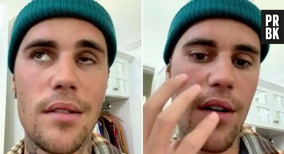 Justin Bieber mostrou rosto paralisado aos fãs no Instagram por conta da doença