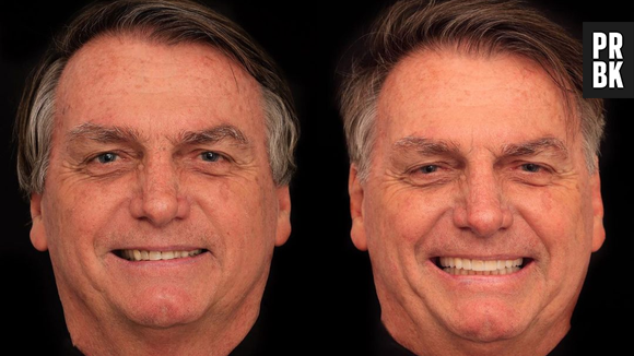 Antes e depois de Bolsonaro após harmonização facial