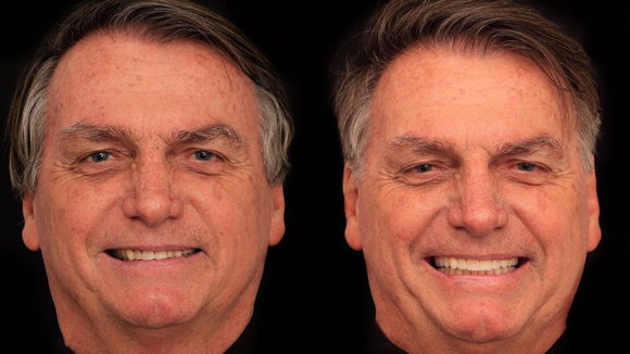 Jair Bolsonaro gasta R$ 84 mil em harmonização facial e web não perdoa: "Perdeu tudo, virou influencer"