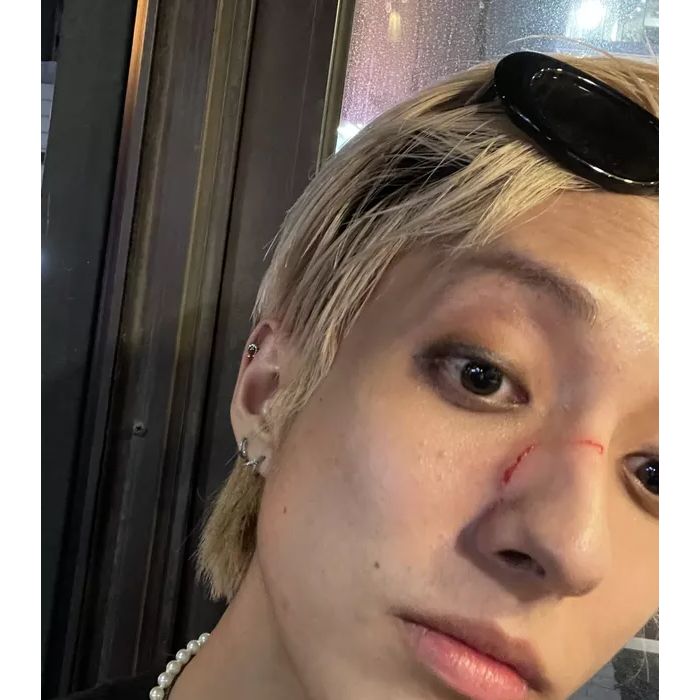 Holland, cantor de k-pop, exibe rosto machucado após agressão de homofóbico