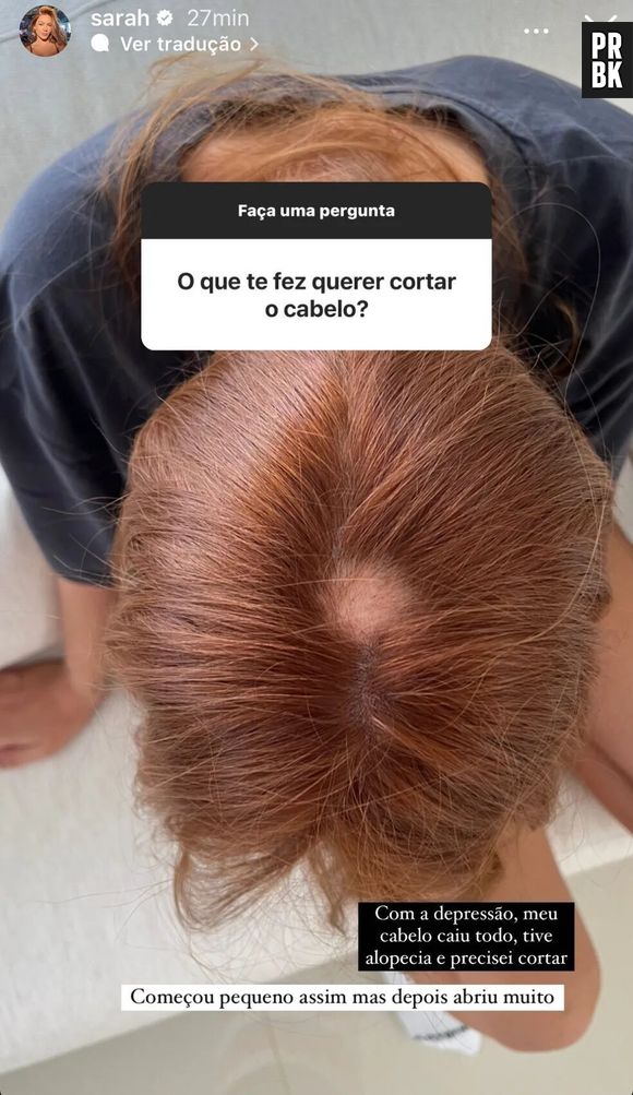 Sarah teve alopecia por causa da depressão