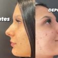 Antes e depois do nariz de Ana Castela