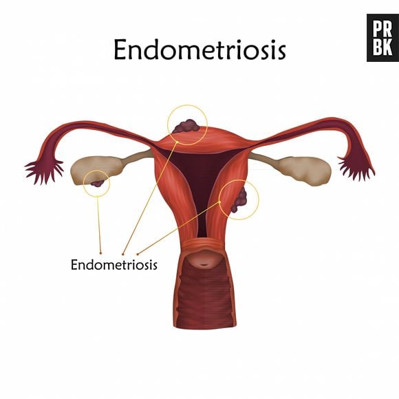 Endometriose: ilustração explica a doença