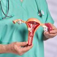 Endometriose acontece quando o tecido endometrial vai para fora do útero
