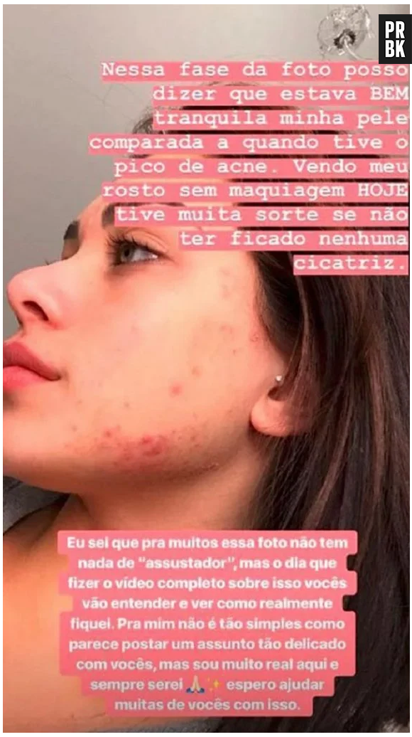 Flavia Pavanelli mostra rosto com espinhas