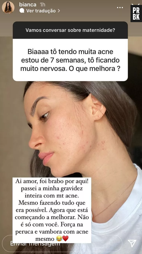 Bianca Andrade lidou com acne no puerpério