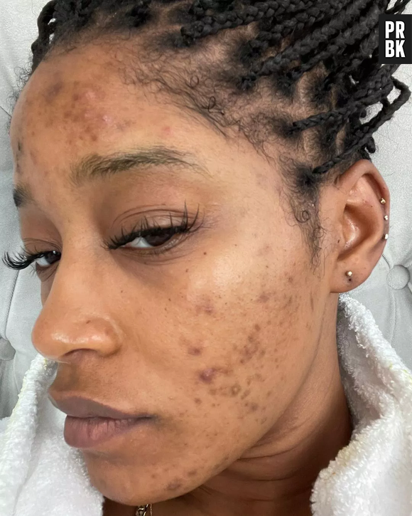 Keke Palmer exibe rosto com acne e mostra pele sem filtros