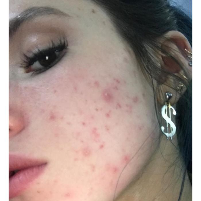 Bella Thorne exibe marcas de espinhas no rosto em foto sem filtro