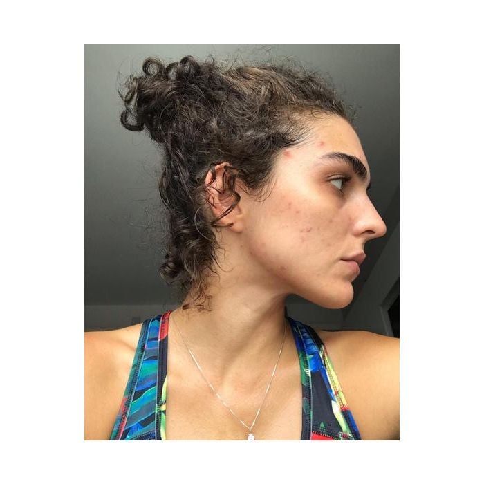 Julia Konrad exibe pele sem filtros e com espinhas no Instagram