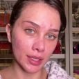 Flavia Pavanelli exibe rosto sem filtro e fala sobre tratamento contra a acne