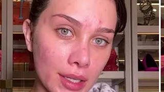 Acne adulta: 15 famosas que exibiram a pele natural e dividiram suas inseguranças