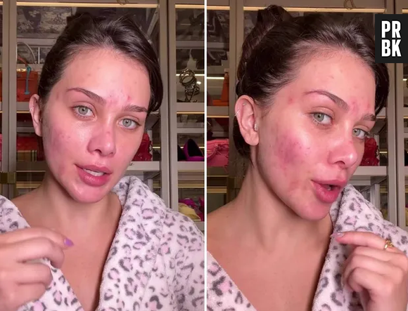 Flavia Pavanelli exibe rosto sem filtro e fala sobre tratamento contra a acne