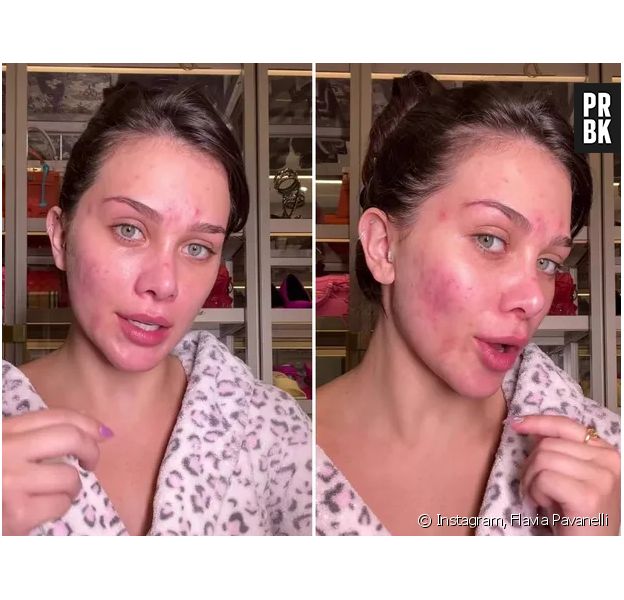 Flavia Pavanelli exibe rosto sem filtro e fala sobre tratamento contra a acne