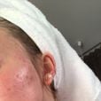 " minha pele está ruim, mas tudo bem", disse Zara Larsson em foto do rosto sem filtro 