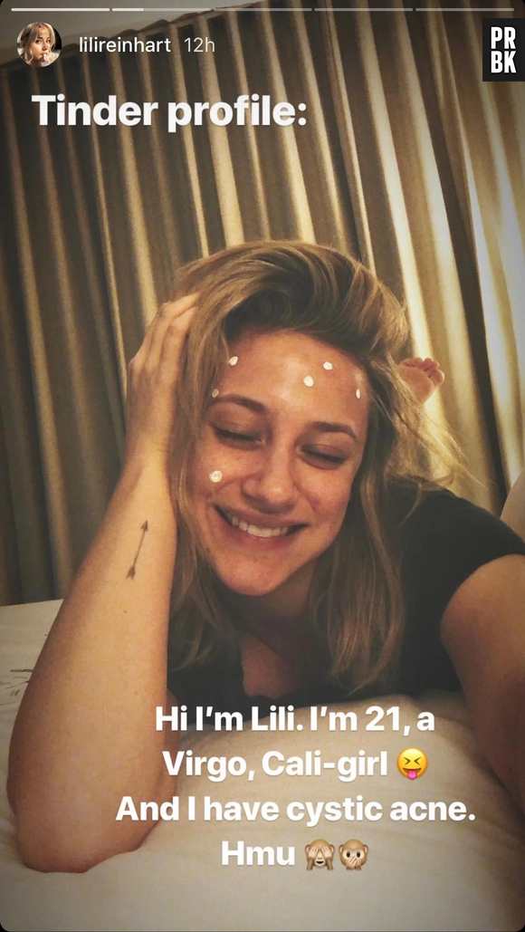 Lili Reinhart exibe rosto com produtos durante tratamento contra acnes