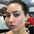 Rafa Kalimann mostra rosto com acne e confessa que problema afetou  autoestima: 'Me culpava