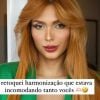 Fernanda Campos mostrou resultado após retocar harmoniação facial