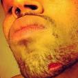 Depois da briga com Drake, que destruiu uma boate em Nova York, Chris Brown compartilhou uma foto dos ferimentos do combate