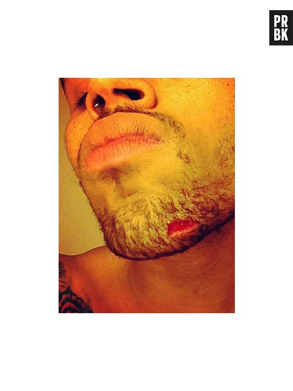 Depois da briga com Drake, que destruiu uma boate em Nova York, Chris Brown compartilhou uma foto dos ferimentos do combate