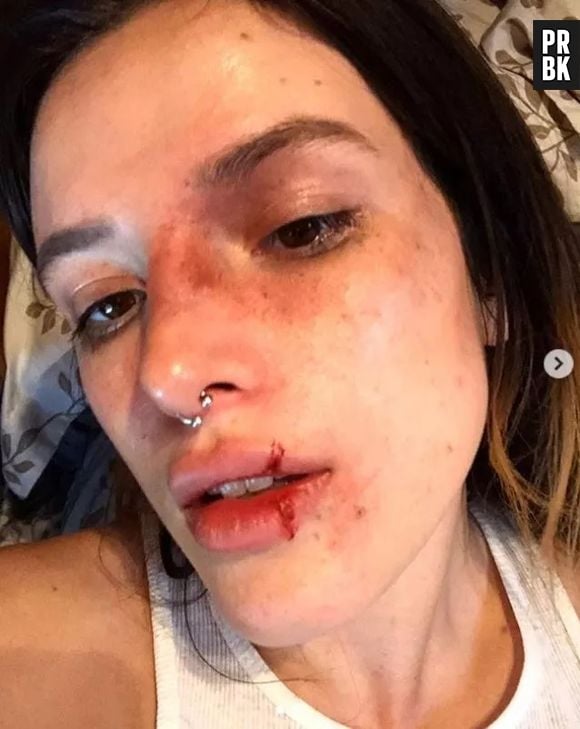 Bella Thorne causou polêmica ao aparecer com rosto machucado no Halloween