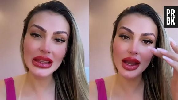 Boca de Andressa Urach impressiona por tamanho após procedimento. Modelo fez tratamento "efeito batom"