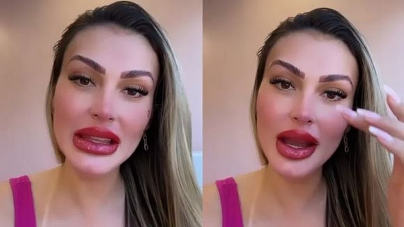 Boca de Andressa Urach impressiona por tamanho após procedimento. Modelo fez tratamento "efeito batom"