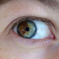 Laser promete mudar a cor dos olhos castanhos para azuis e pode ser aplicado por 5 mil dólares