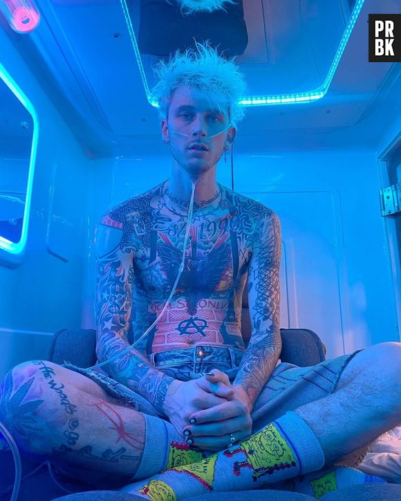 Machine Gun Kelly ainda tem cicatriz do transplante capilar feito para reverter a calvície prematura