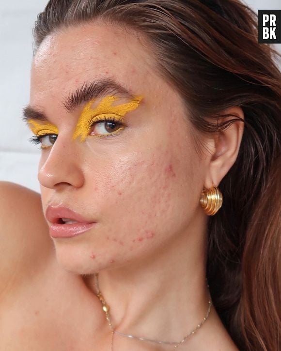 Acne, cicatriz, estrias: 6 influencers que provam que a pele perfeita não existe