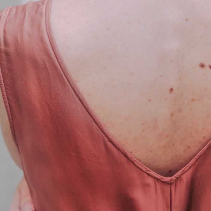 A acne pode acontecer em várias fases da vida, por diversos motivos