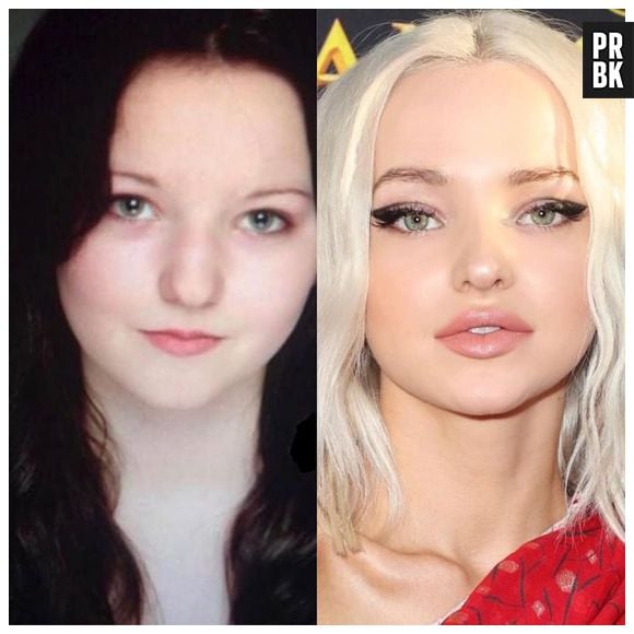 Dove Cameron passou por rinoplastia e algumas intervenções estéticas