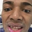 Nego do Borel exibe dentes sem lentes de contato