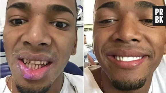 Nego do Borel exibe dentes sem lentes de contato